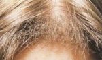 bleachdamage5